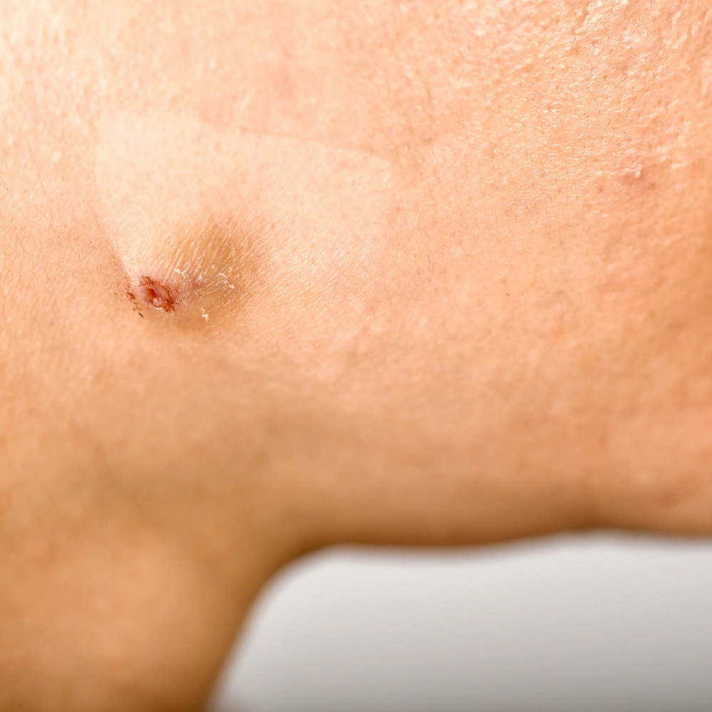 Cystic acne