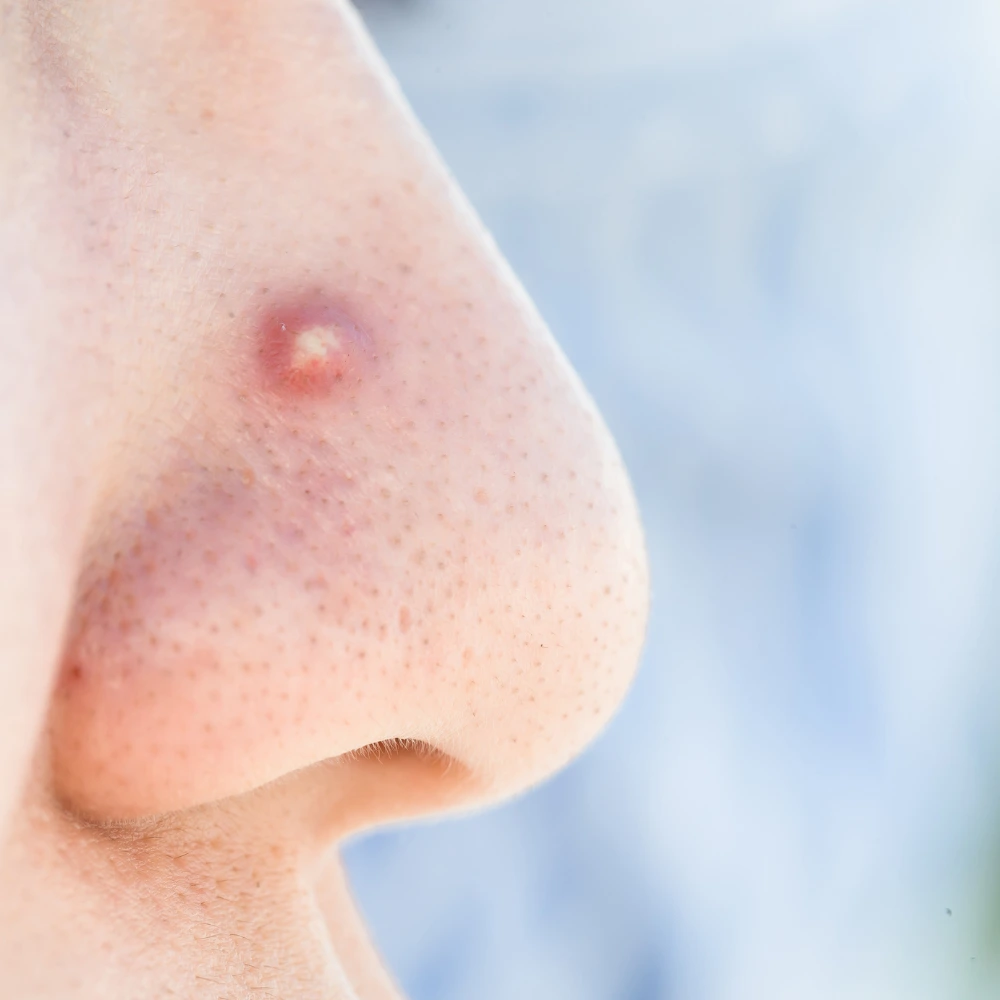 Pustules on skin