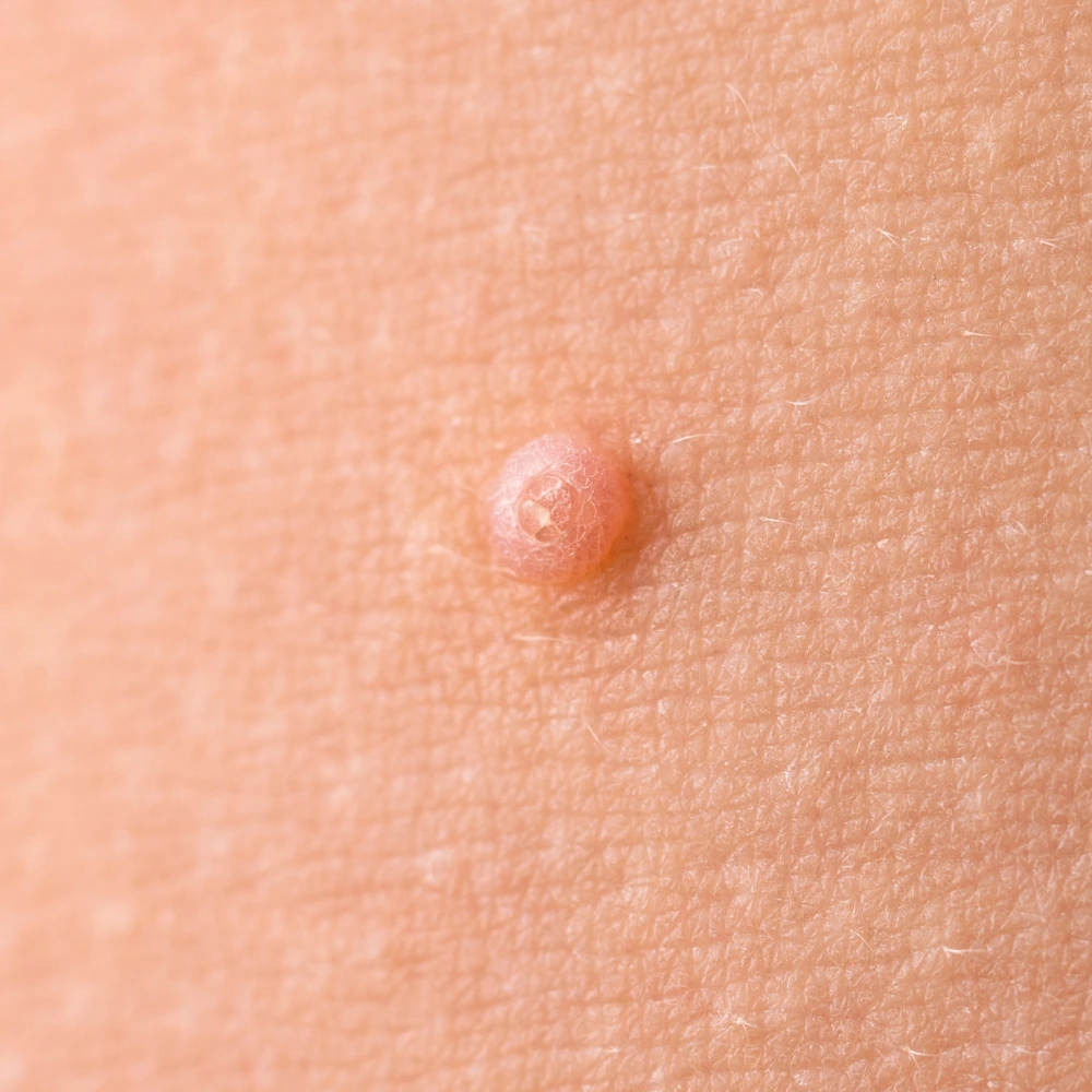 Nodular acne